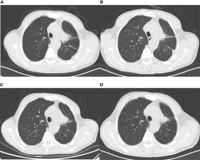 Drug-induced liver injury associated with dacomitinib: A case report